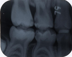 歯のレントゲン写真