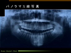 パノラマX線写真