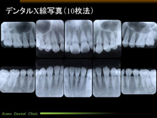 デンタルX線写真