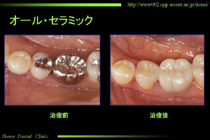 オールセラミック