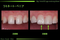 ラミネートべニア