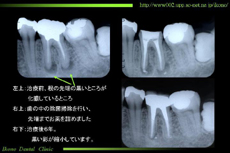 歯の根っこが化膿した状態