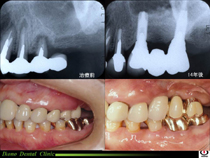 上顎奥歯インプラント