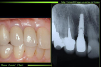 前歯のインプラント